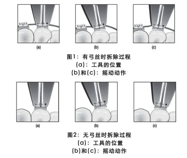 3M Unitek Gemini Clear MBT直丝弓陶瓷托槽 3M Unitek Gemini Clear MBT直丝弓陶瓷托槽
