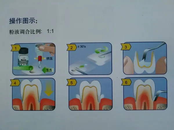 VOCO 美龙玻璃离子水门汀.webp