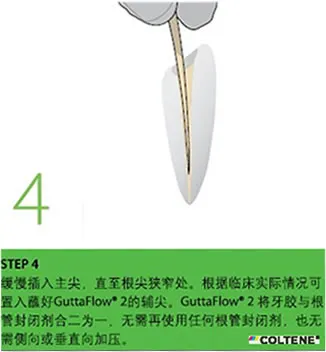 康特 GuttaFlow 2根管充填常温流动牙胶4.webp 康特 GuttaFlow 2根管充填常温流动牙胶4.webp