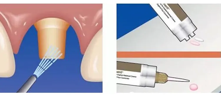 普米尔 Premier Implant Cement种植粘接剂全接触_r2_c1.webp