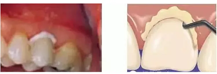 普米尔 Premier Implant Cement种植粘接剂全接触_r4_c1.webp
