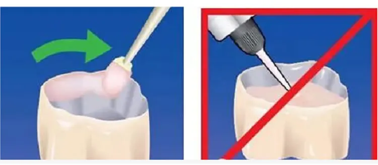 普米尔 Premier Implant Cement种植粘接剂全接触_r3_c1.webp