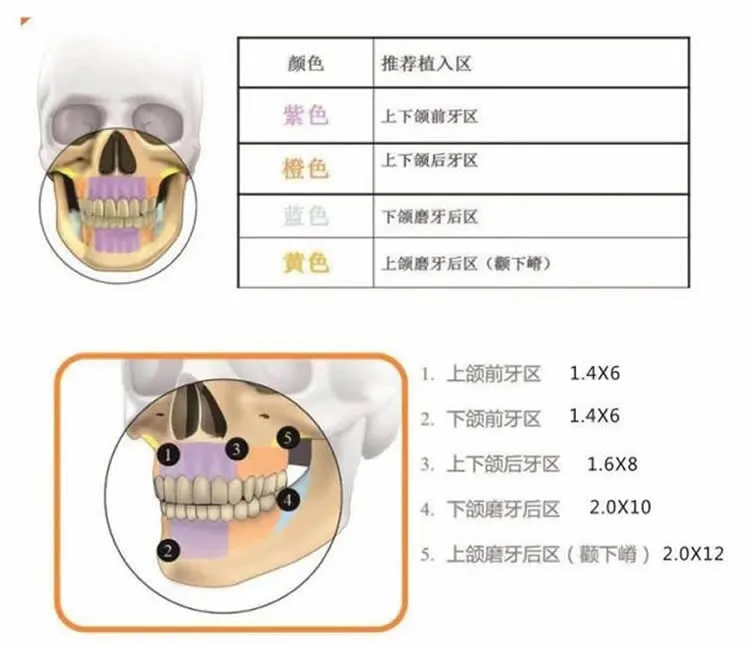 普特 PT III Plus 颅颌面接骨螺钉2_r3_c1.webp