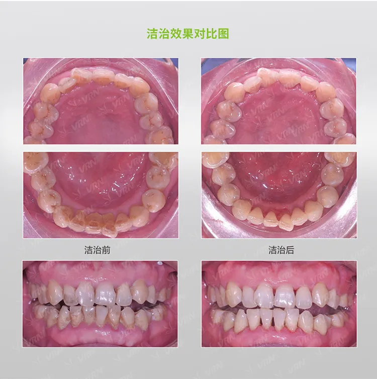 维润 超声喷砂牙周治疗仪VRN-Q6-2_r5_c1.webp