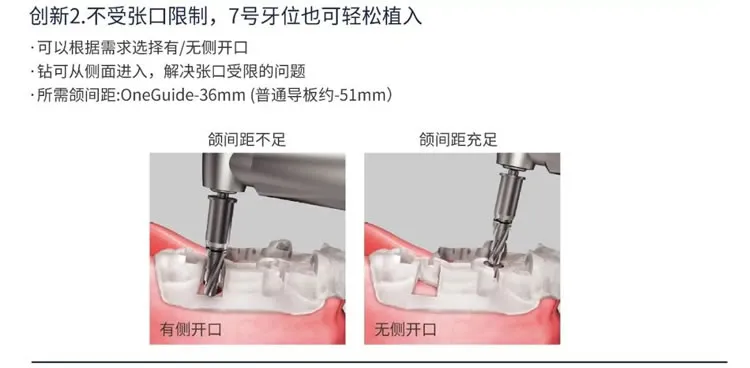 奥齿泰  导板工具盒  One Guide KIT-1_r2_c1.webp