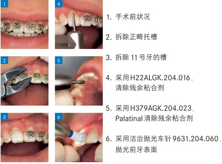 固美 粘结剂清楚车针a.webp 固美 粘结剂清楚车针a.webp