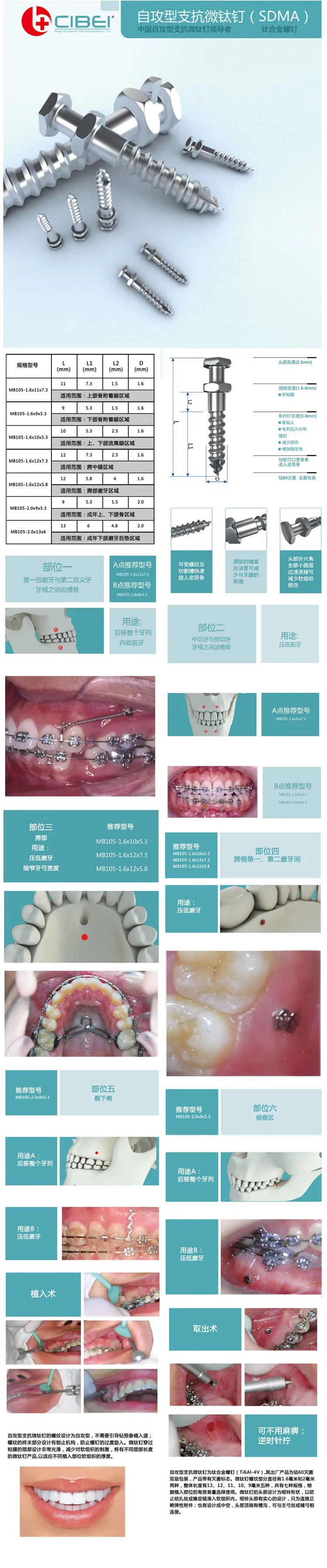 慈北支抗钉2.webp