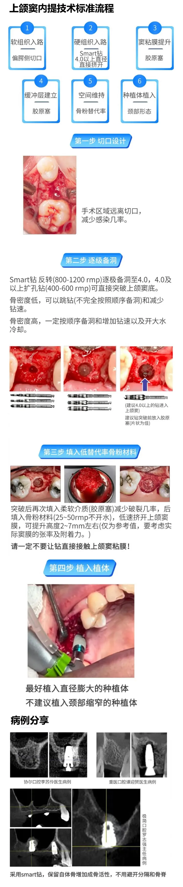 西科码  上颌窦套装1.webp