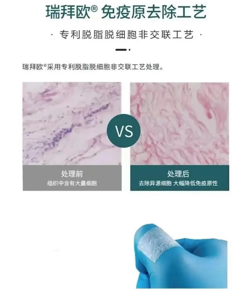瑞拜欧 骨膜1_r2_c1.webp 瑞拜欧 骨膜1_r2_c1.webp