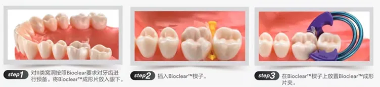 3M ESPE Bioclear牙科成形片套装(后牙)827051-2.webp 3M ESPE Bioclear牙科成形片套装(后牙)827051-2.webp