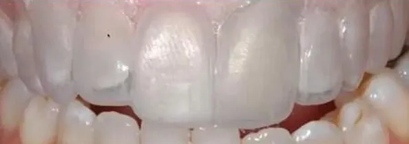 烤瓷贴面备牙技术