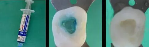 关注临床常规操作---关于酸蚀与粘结(一) 关注临床常规操作---关于酸蚀与粘结(一)