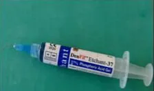 关注临床常规操作---关于酸蚀与粘结(一) 关注临床常规操作---关于酸蚀与粘结(一)
