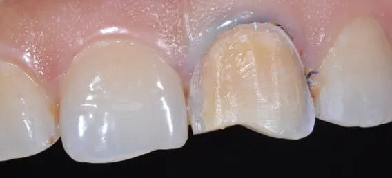 烤瓷贴面0.3毫米如何体现出颜色和形态 
