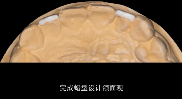 美学蜡型---简易操作理念