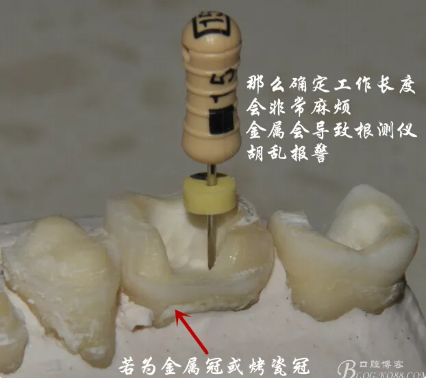 钢牙 烤瓷冠 不破冠确定工作长度(小方法) 钢牙 烤瓷冠 不破冠确定工作长度(小方法)