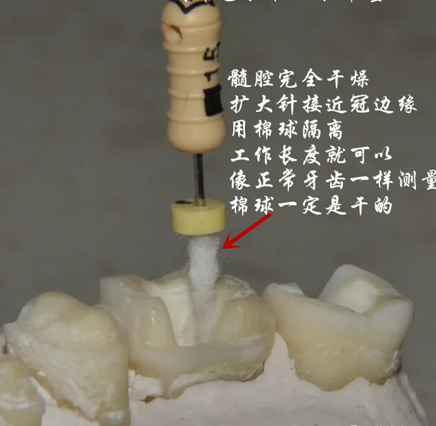 钢牙 烤瓷冠 不破冠确定工作长度(小方法) 钢牙 烤瓷冠 不破冠确定工作长度(小方法)