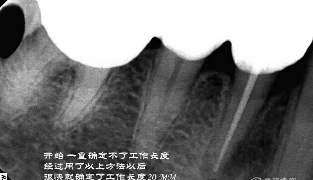 钢牙 烤瓷冠 不破冠确定工作长度(小方法) 钢牙 烤瓷冠 不破冠确定工作长度(小方法)