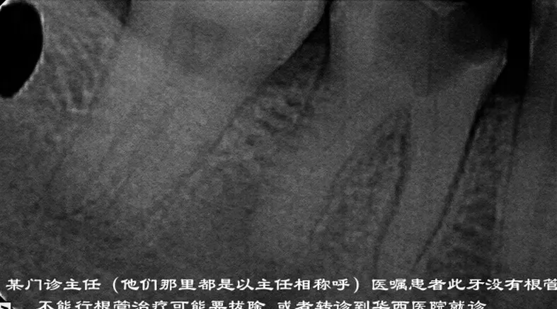 根管再 ——治疗