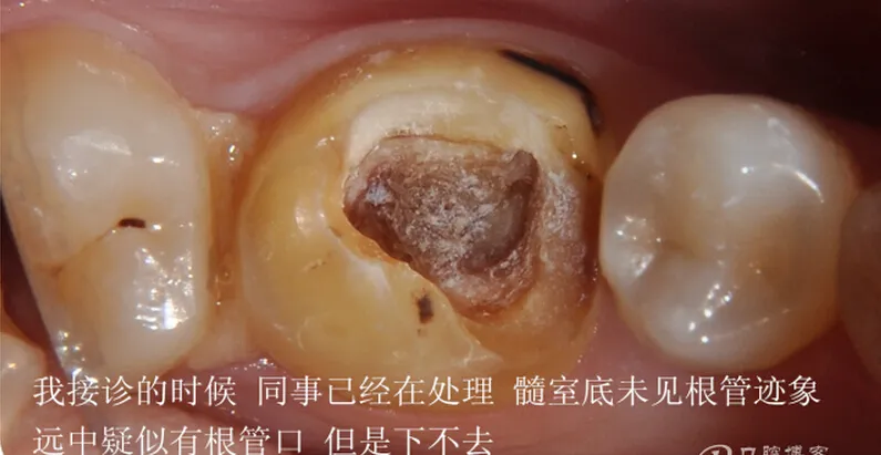 根管再 ——治疗