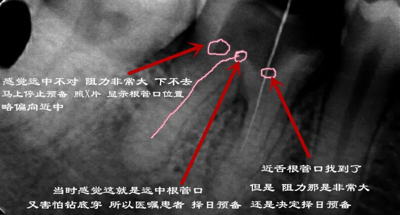 根管再 ——治疗