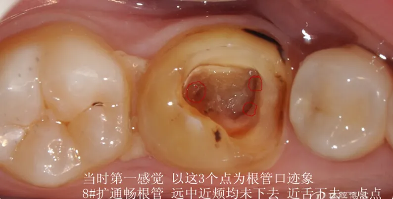根管再 ——治疗
