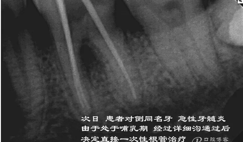 根管再 ——治疗