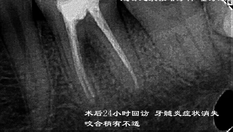 根管再 ——治疗