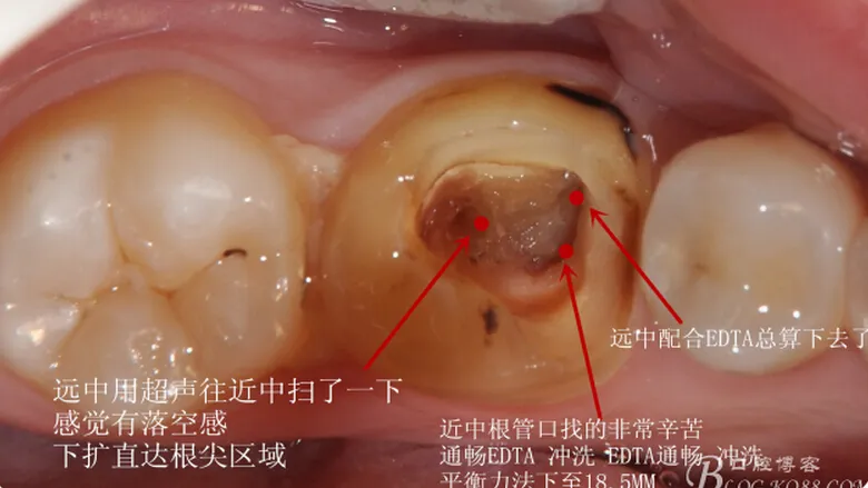 根管再 ——治疗