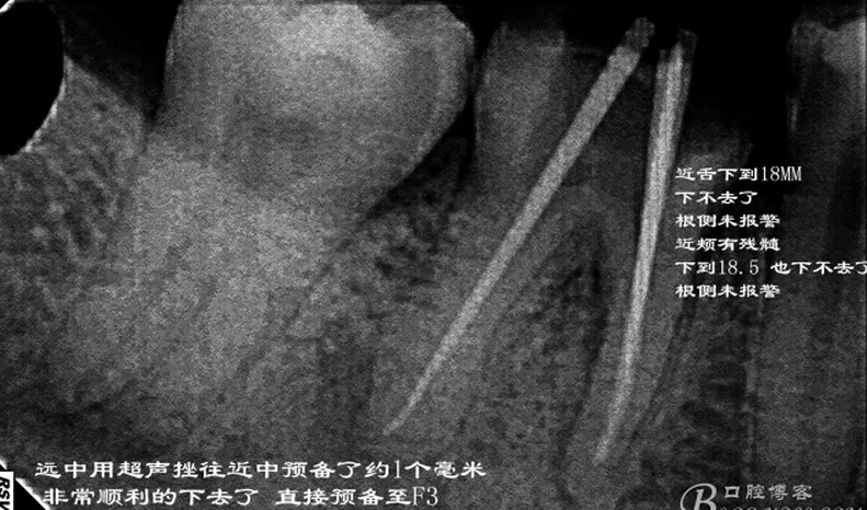 根管再 ——治疗