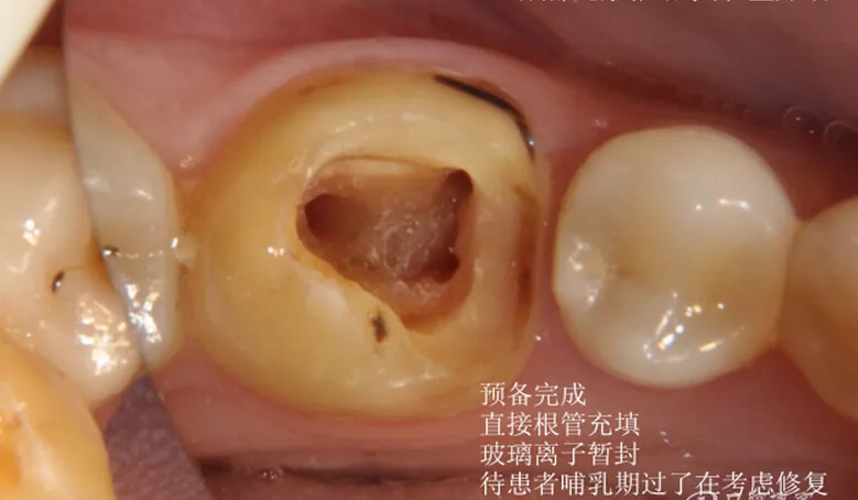 根管再 ——治疗